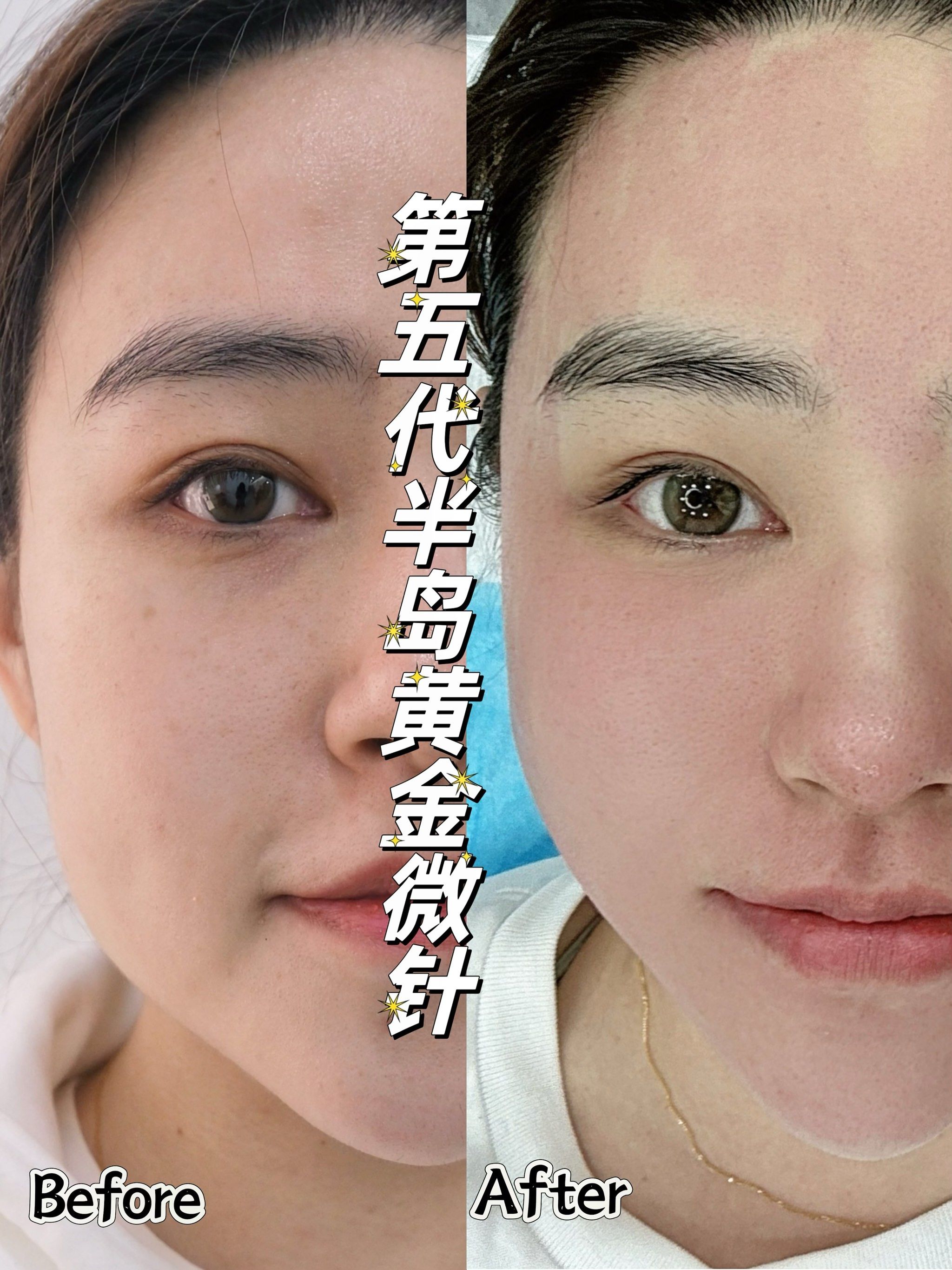 花5万元打的美容针,竟是修复骨缺损的骨科材料,约定注射的部位还没打就收费!美容所已被立案