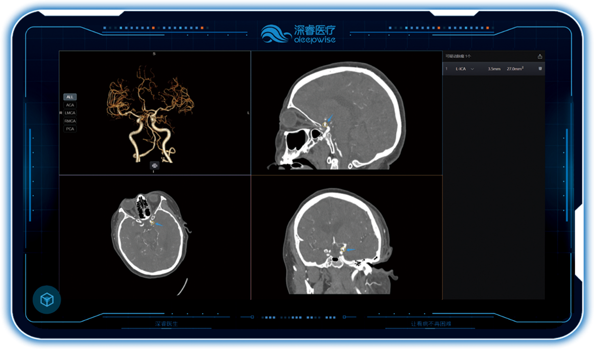 翔宇医疗：公司牵头申报的项目近日成功入围2025年人工智能医疗器械创新任务揭榜挂帅名单
