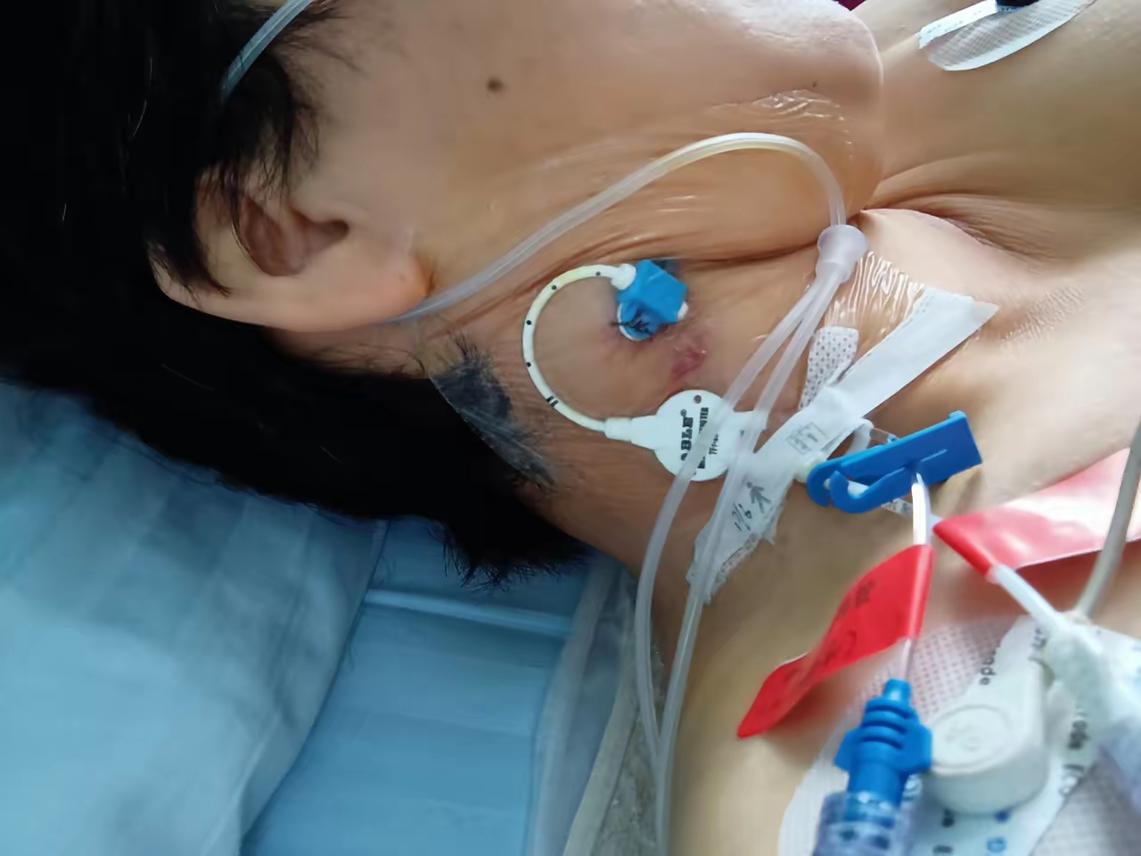 人工肺助患者接受器官移植前成功生存48小时